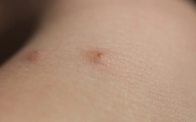 Recognizing and Treating Bedbug Bites